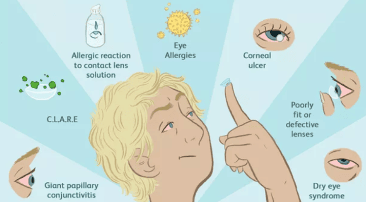 دلایل قرمز شدن چشم با لنز تماسی